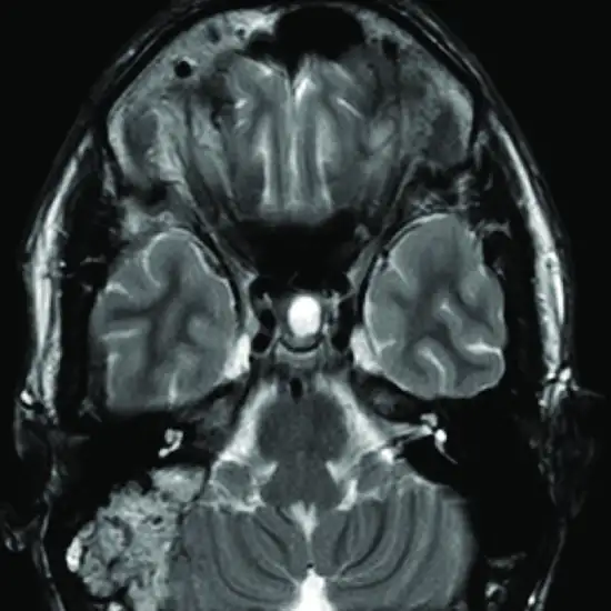 MRI Screening Temporal Bone